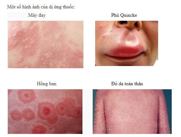 Dị ứng thuốc tây và cách chữa hiệu quả tại nhà Dị ứng thuốc tây và cách chữa hiệu quả tại nhà
