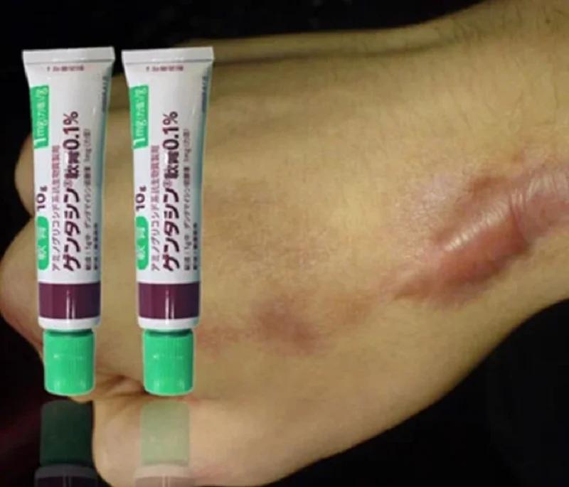 Kem bôi sẹo Gentacin 1% Nhật Bản chuyên dùng cho các loại sẹo Lồi Lõm,lâu năm