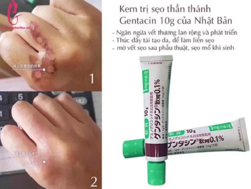Kem bôi sẹo Gentacin 1% Nhật Bản chuyên dùng cho các loại sẹo Lồi Lõm,lâu năm